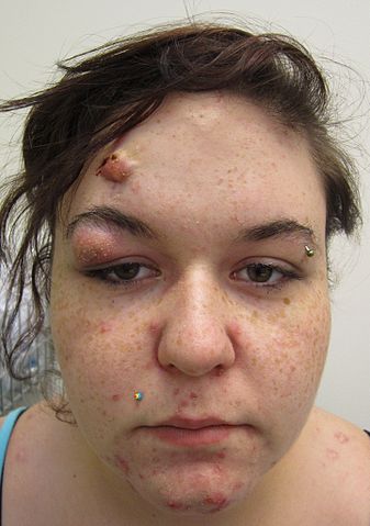 File:Cysticacne.JPG