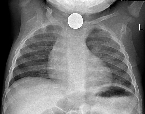 File:Coin in esophagus 2.jpg