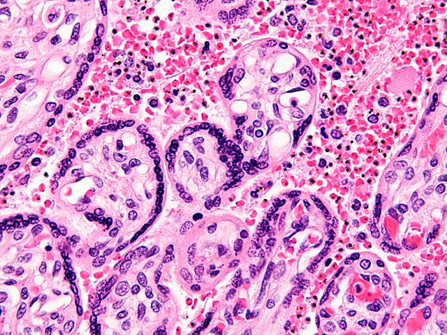 File:Maternal malaria placenta - cropped - very high mag.jpg