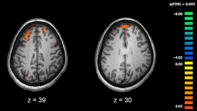 File:Schizophrenia fMRI working memory.jpg