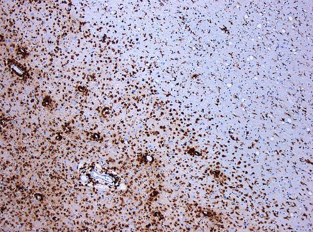 File:MS Demyelinisation CD68 10xv2.jpg