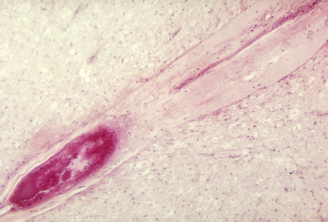 File:Polio spine.png