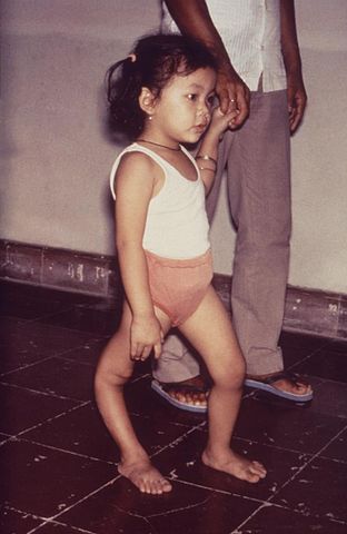 File:Polio sequelle.jpg