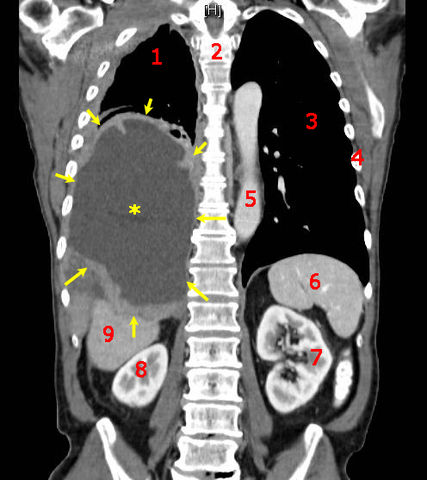 File:Tumor Mesothelioma2 legend.jpg