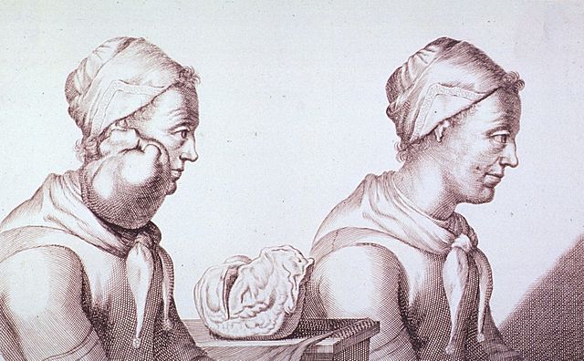 File:Clara Jacobi-Tumor.jpg