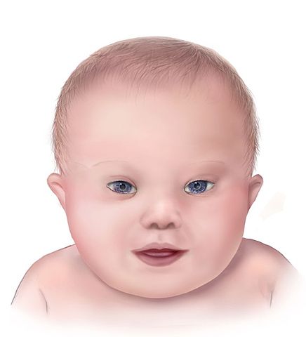 File:Down syndrome lg.jpg