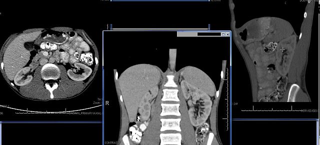 File:CTscankidney.jpg