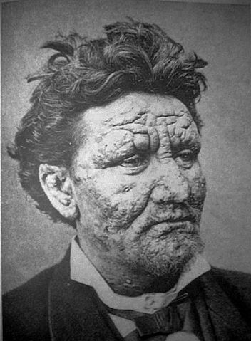 File:Leprosy.jpg