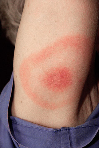 File:Erythema migrans - erythematous rash in Lyme disease - PHIL 9875.jpg