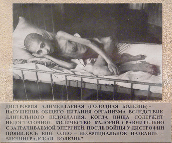 File:Дистрофия алиментарная.jpg