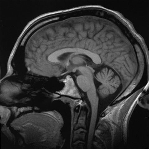File:Brain chrischan.jpg
