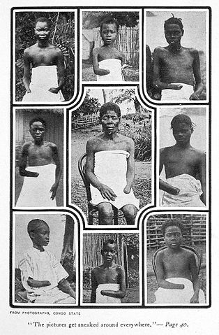 File:MutilatedChildrenFromCongo.jpg