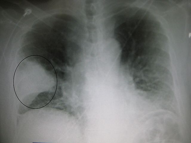 File:PneumonisWedge09.JPG