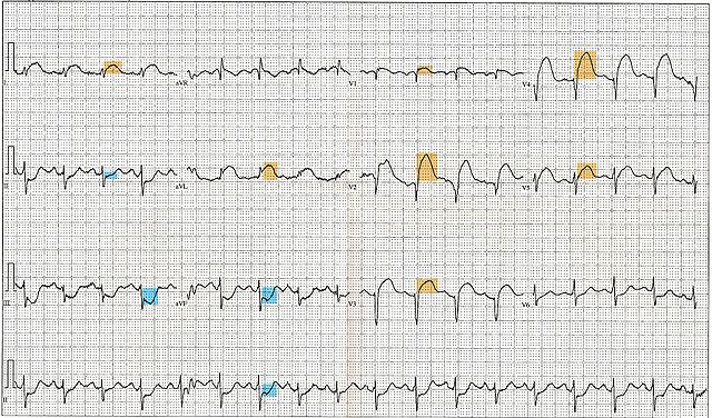 File:12 Lead EKG ST Elevation tracing color coded.jpg