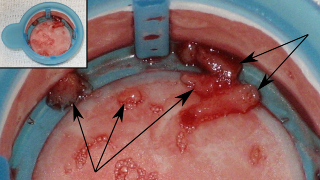File:Intracoronary thrombus.png