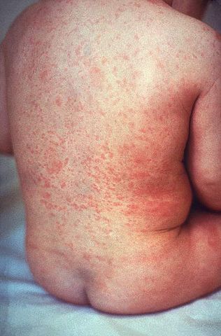 File:Rash of rubella on skin of child's back.JPG