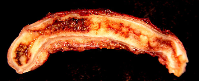 File:Acute Appendicitis.jpg