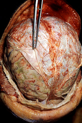 File:Streptococcus pneumoniae meningitis, gross pathology 33 lores.jpg