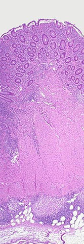 File:Crohn's transmural path.jpg