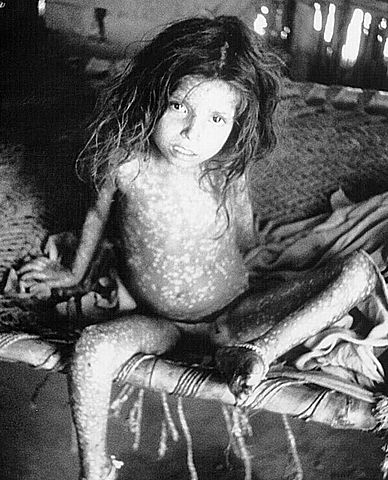 File:Smallpox child.jpg