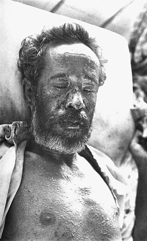 File:Hemorrhagic smallpox.jpg