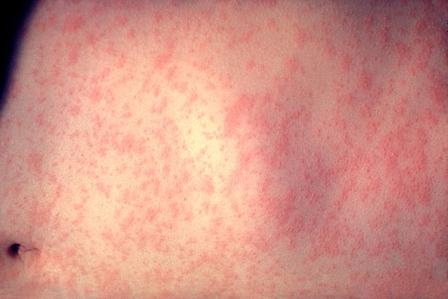 File:Morbillivirus measles infection.jpg