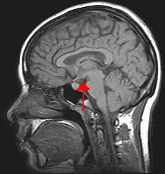 File:Hypothalamus.jpg