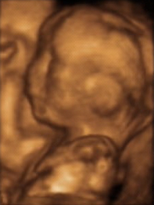 File:3dultrasound 20 weeks.jpg