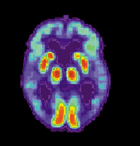 File:PET Alzheimer.jpg